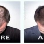 New Jersey hair loss treatment